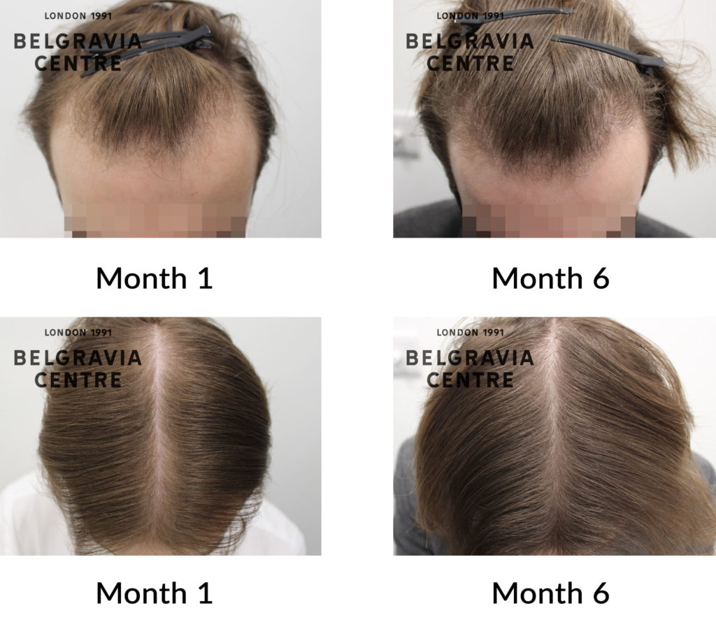 male pattern hair loss the belgravia centre 426875 1024x907