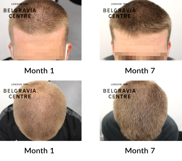 male pattern hair loss the belgravia centre 427034