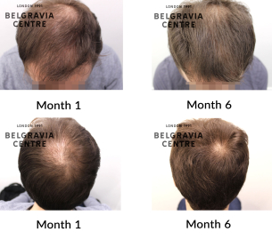 male pattern hair loss the belgravia centre 464139