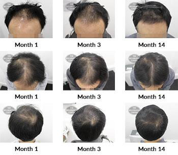 alert male pattern hair loss the belgravia centre 405214 01 10 2021
