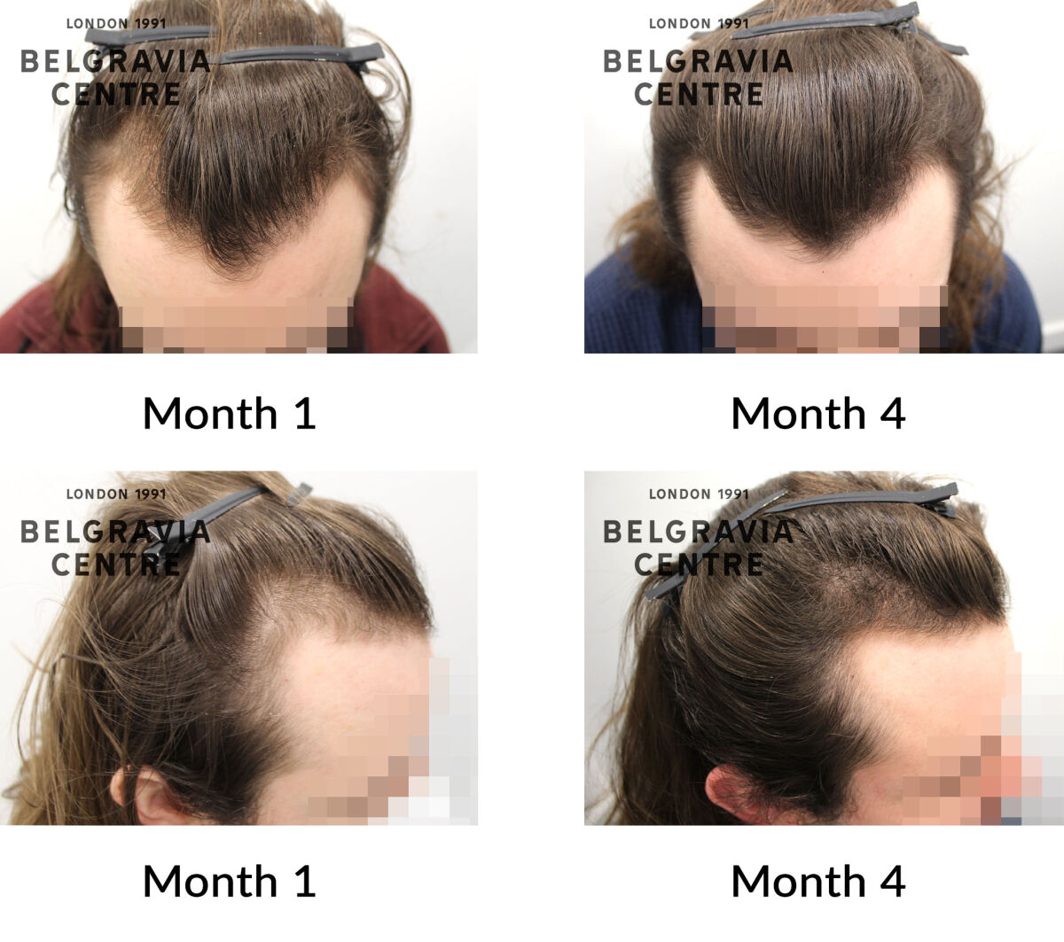 male pattern hair loss the belgravia centre 436184