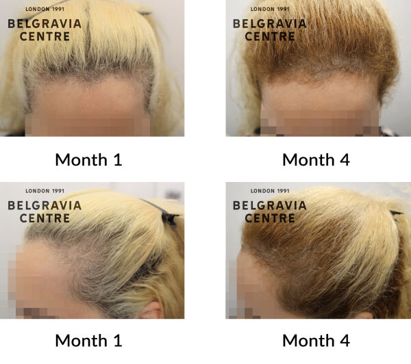female pattern hair loss the belgravia centre 437657
