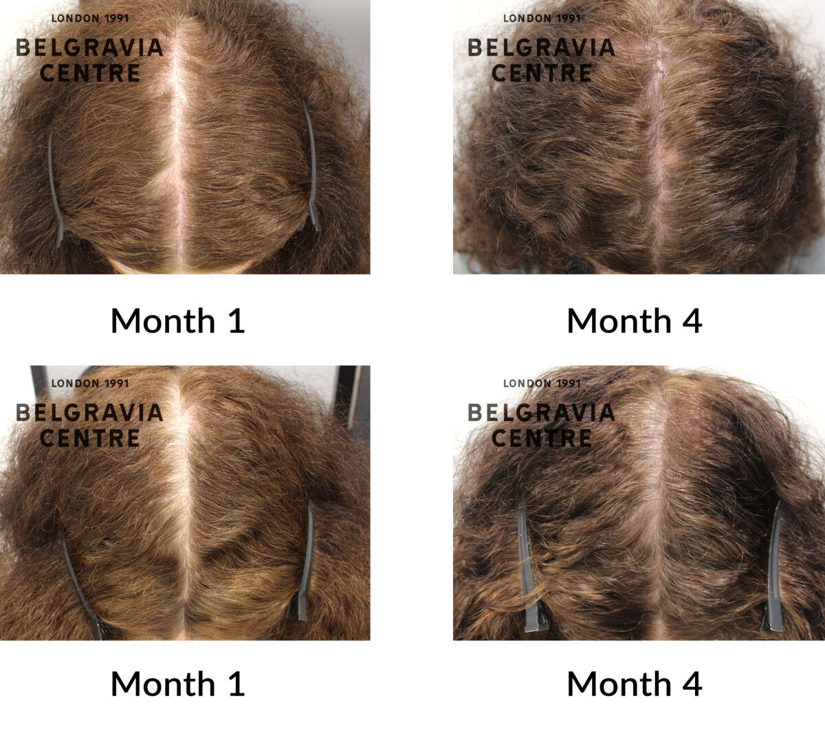 alopecia areata and female pattern hair loss the belgravia centre 442849