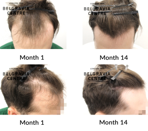 male pattern hair loss the belgravia centre 425093