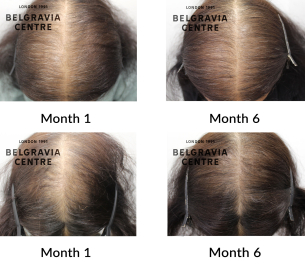 female pattern hair loss the belgravia centre 451898