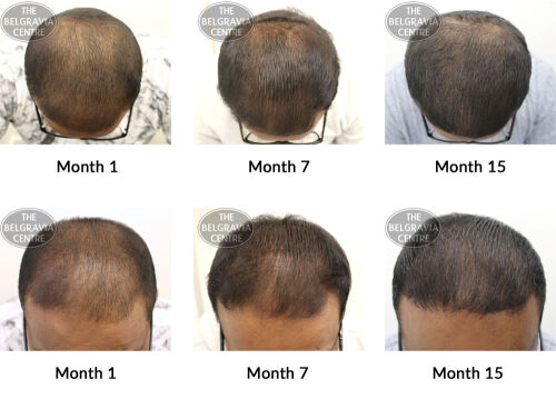 male pattern hair loss the belgravia centre ss 28 12 2018