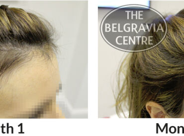 Female Pattern Hair Loss and Chronic Telogen Effluvium Patient Successfully Treated by The Belgravia Centre Hair Loss Clinic