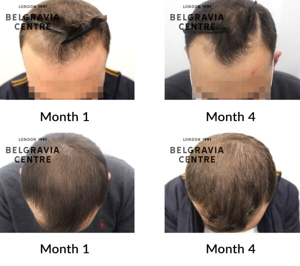 male pattern hair loss the belgravia centre 435373
