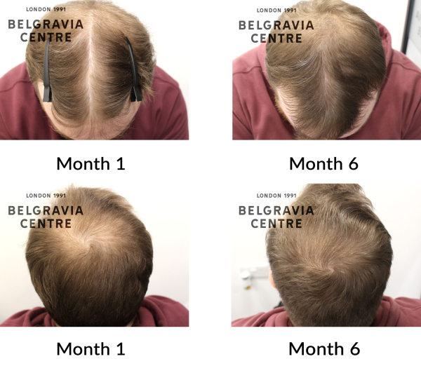male pattern hair loss the belgravia centre 453598