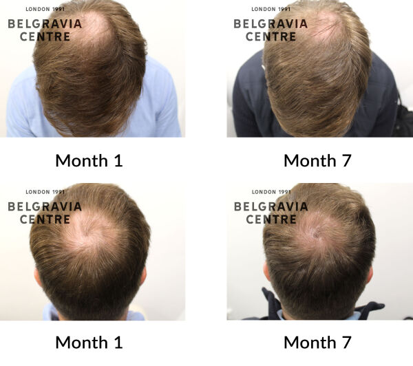 male pattern hair loss the belgravia centre 442919