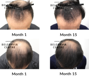 male pattern hair loss the belgravia centre 452948