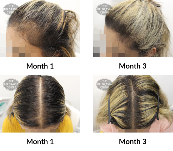 female pattern hair loss the belgravia centre 390579 07 01 2019