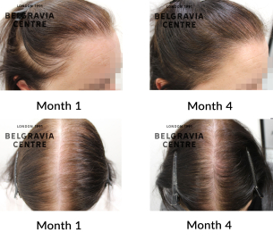 female pattern hair loss the belgravia centre 445426
