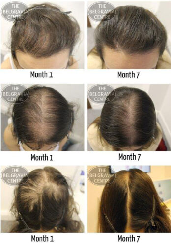 Womens Hair Loss Treated By The Belgravia Centre AC FPA1
