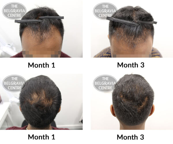 male pattern hair loss the belgravia centre JM 19 02 2019