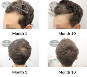 male pattern hair loss the belgravia centre 413327 13 09 2021