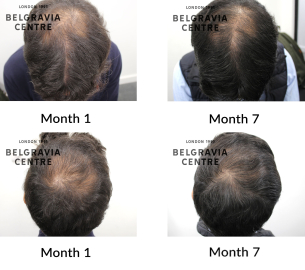 male pattern hair loss the belgravia centre 447331