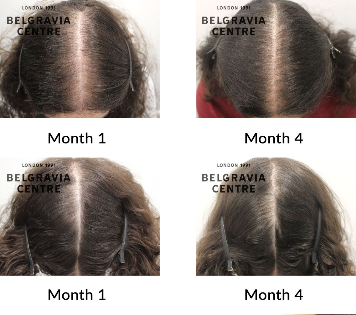 female pattern hair loss the belgravia centre 425637