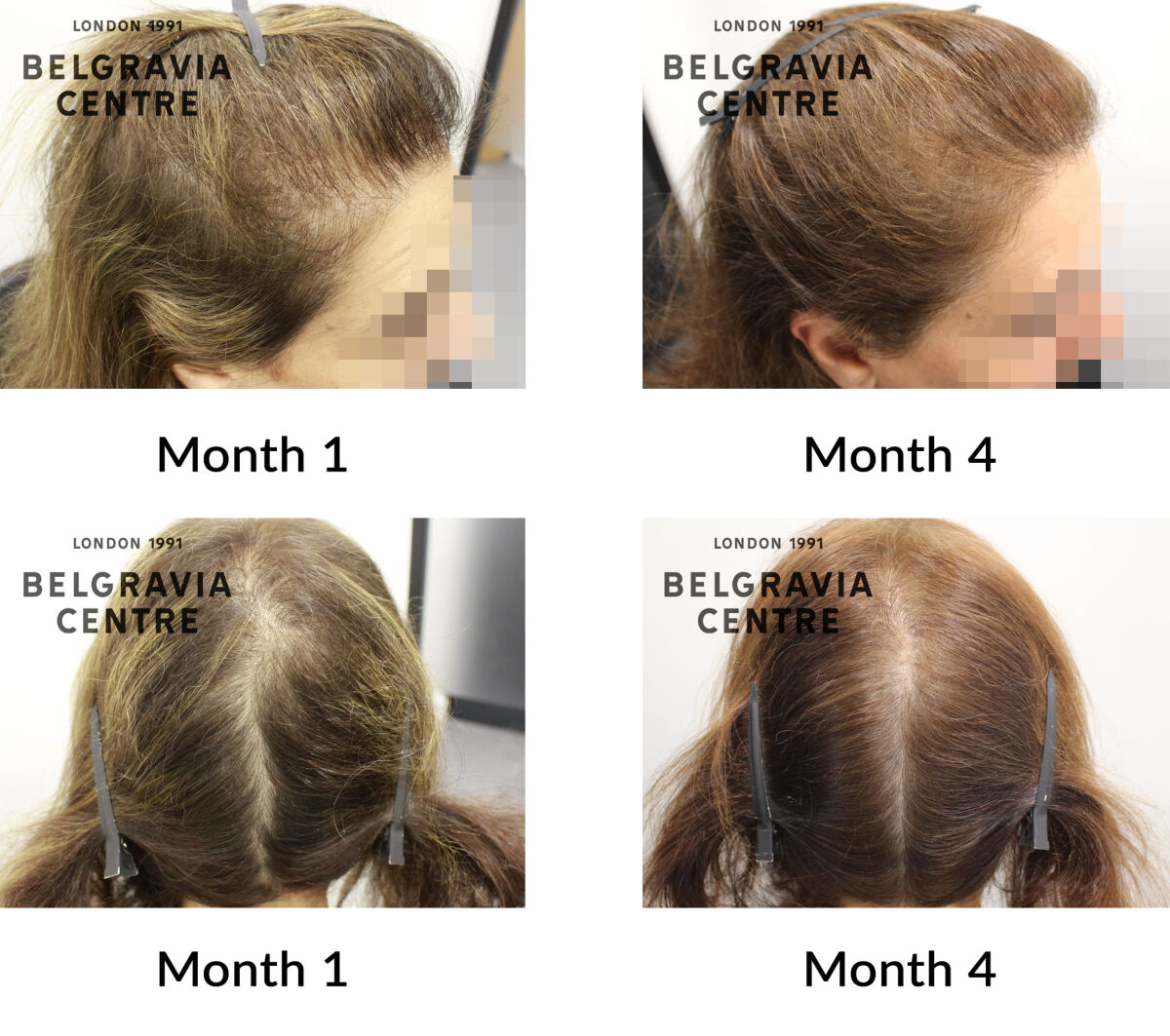 female pattern hair loss the belgravia centre 441771
