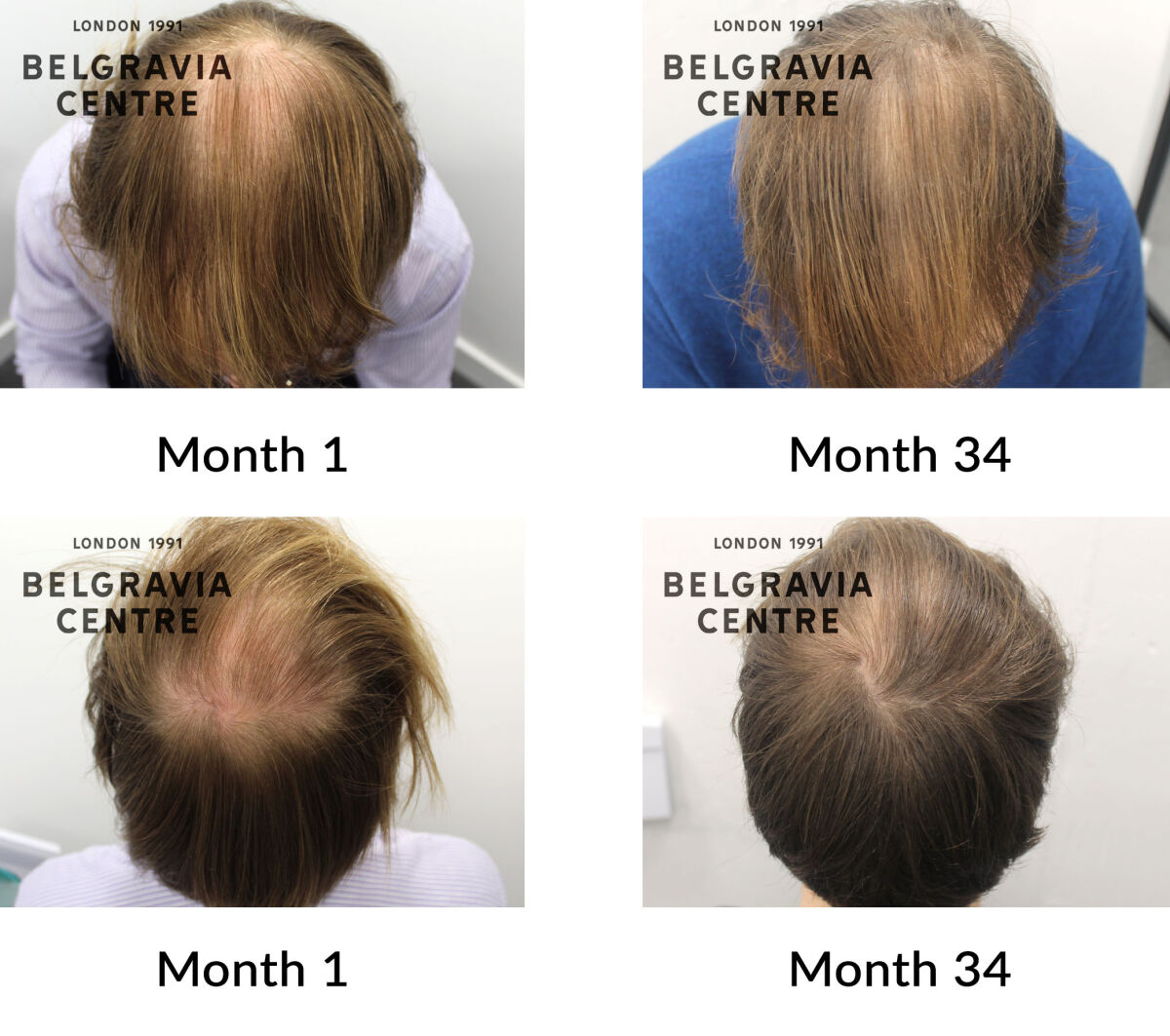 male pattern hair loss the belgravia centre 331639