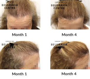 female pattern hair loss and diffuse thinning the belgravia centre 459156