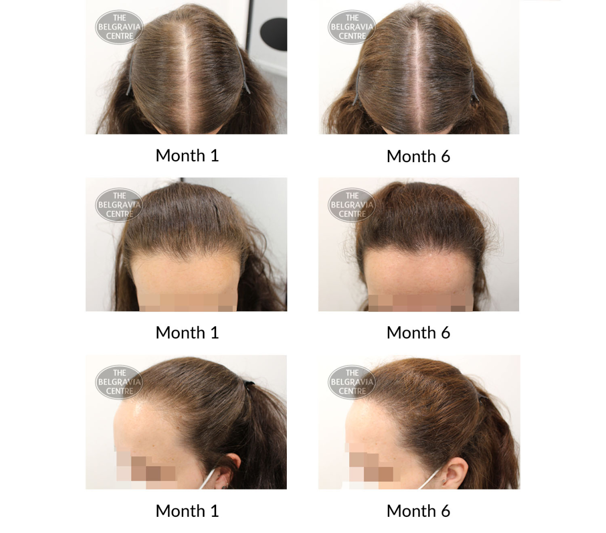 female pattern hair loss the belgravia centre 423776 25 11 21
