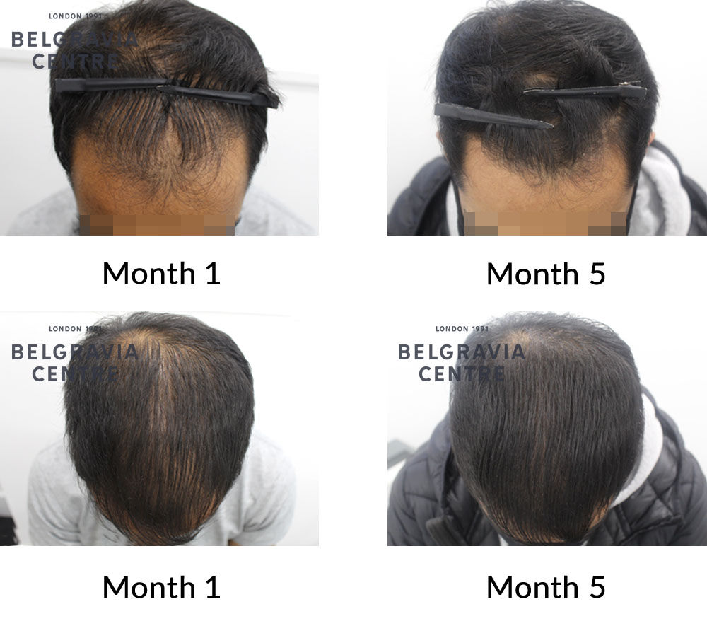 male pattern hair loss the belgravia centre 426573 151221