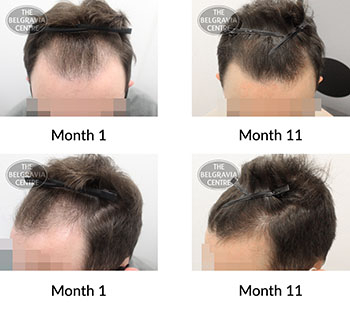 alert male pattern hair loss the belgravia centre 410764 06 09 2021 3