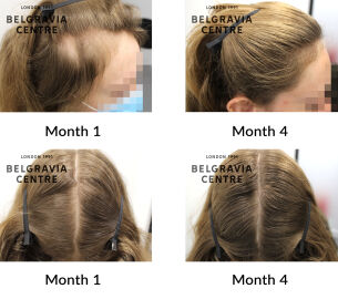 telogen effluvium, congenital alopecia and female pattern hair loss the belgravia centre 437540