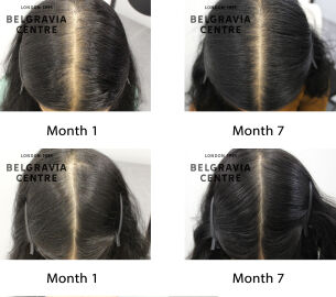female pattern hair loss the belgravia centre 440431