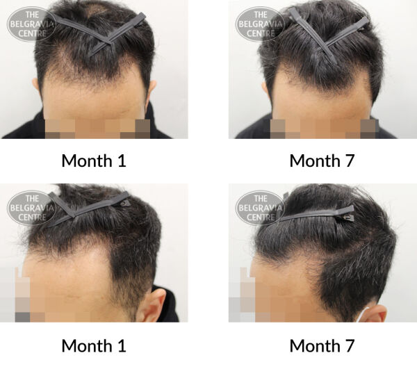 male pattern hair loss the belgravia centre 394957 23 07 2020