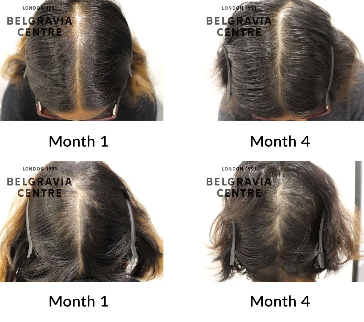 female pattern hair loss the belgravia centre 446263