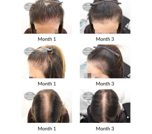 female pattern hair loss the belgravia centre 16 11 2020