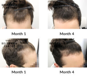 male pattern hair loss the belgravia centre 444517