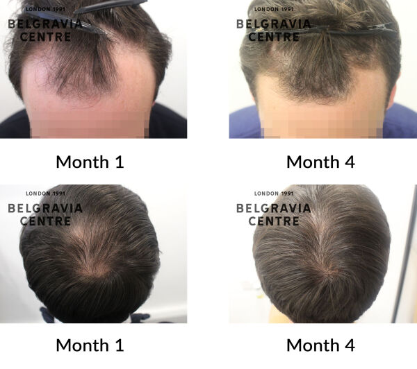 male pattern hair loss the belgravia centre 439012