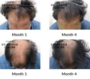male pattern hair loss the belgravia centre 430336
