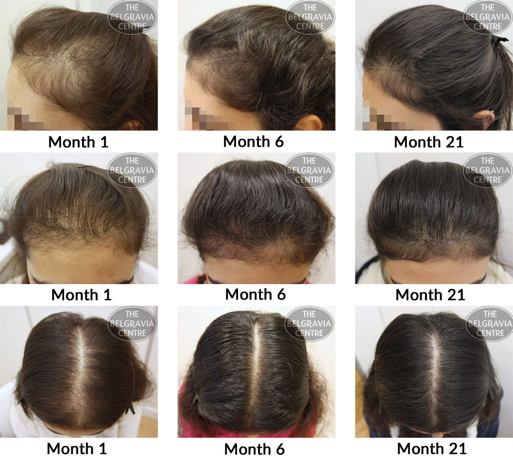 female pattern hair loss the belgravia centre sas 08 11