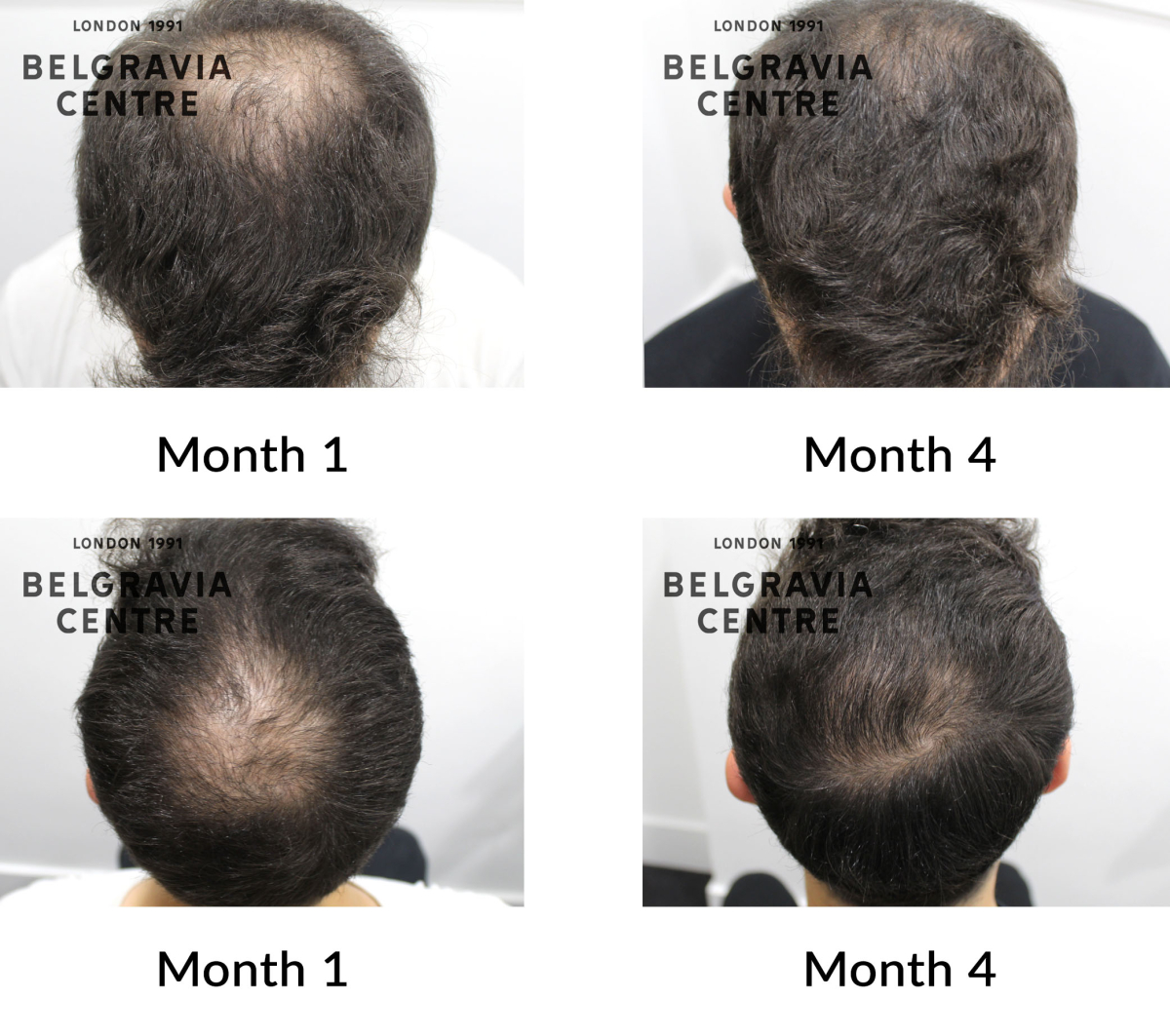 male pattern hair loss the belgravia centre 433806