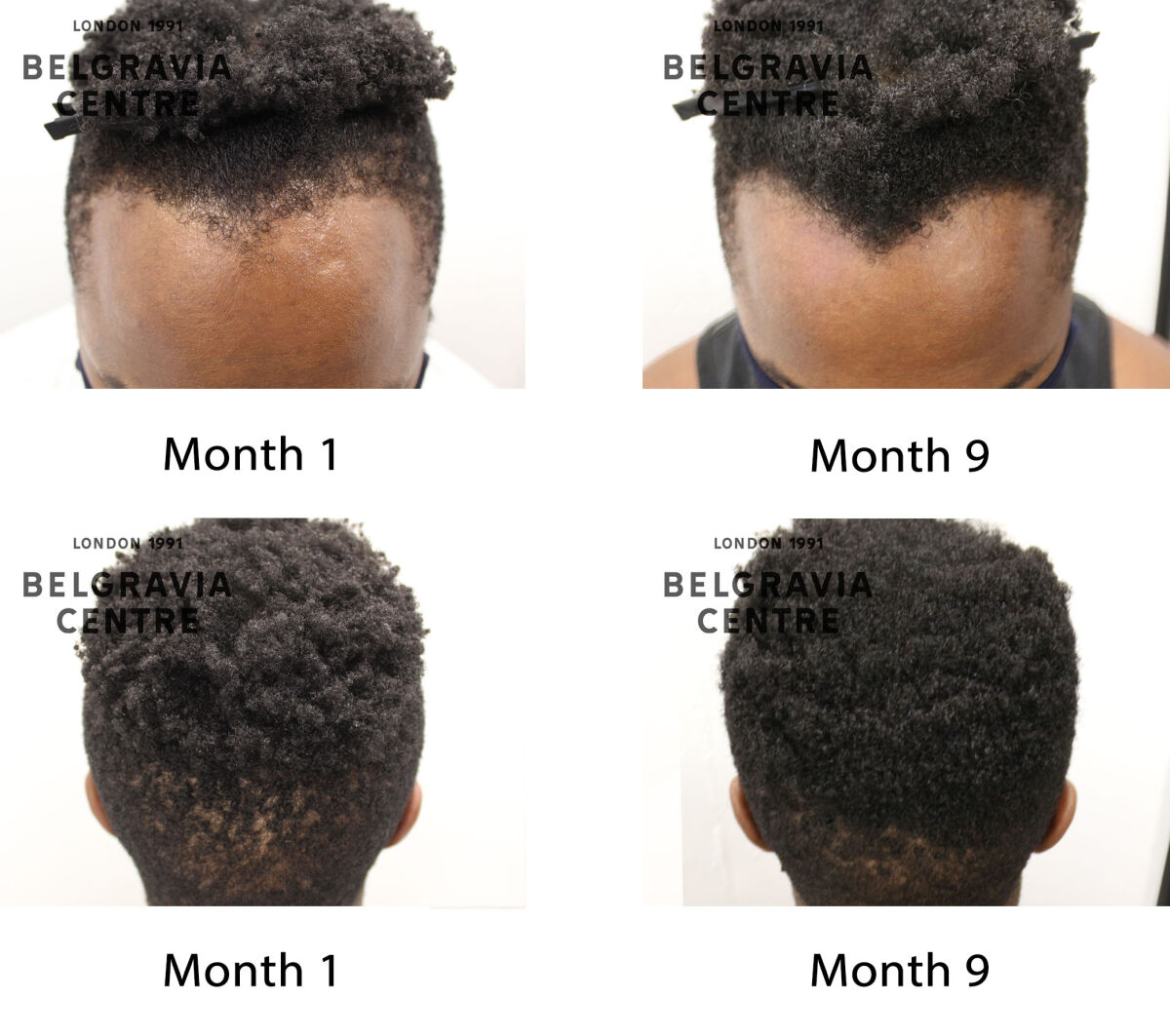 male pattern hair loss the belgravia centre 433625