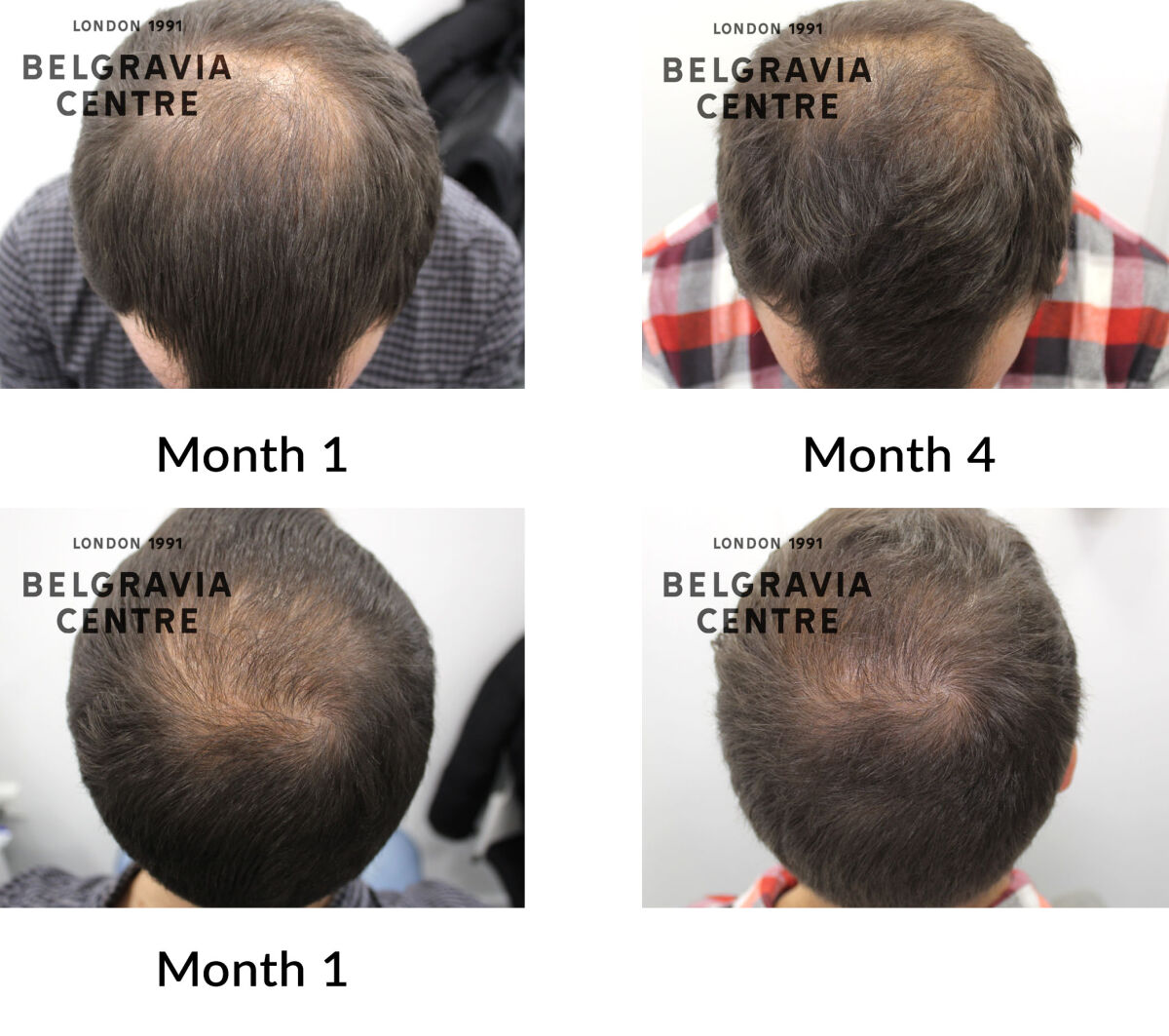 male pattern hair loss the belgravia centre 451745