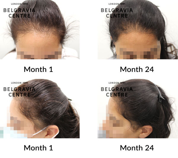 female pattern hair loss and traction alopecia the belgravia centre 403438