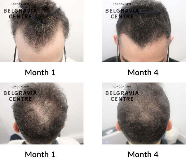male pattern hair loss the belgravia centre 432310