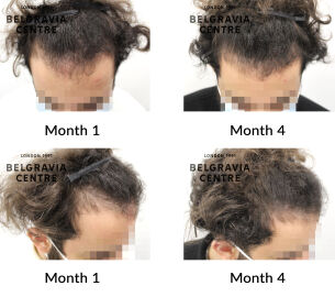 male pattern hair loss the belgravia centre 434338