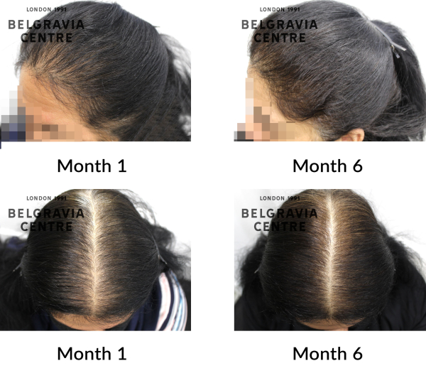 female pattern hair loss the belgravia centre 427044