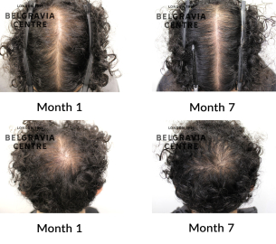 male patern hair loss the belgravia centre 455113