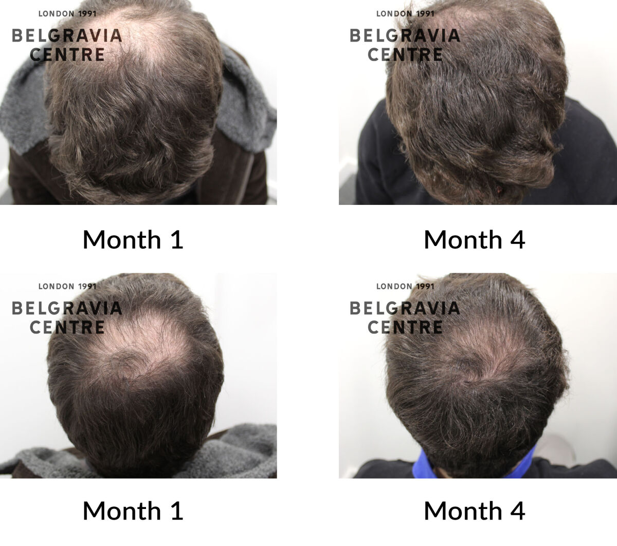 male pattern hair loss the belgravia centre 450332