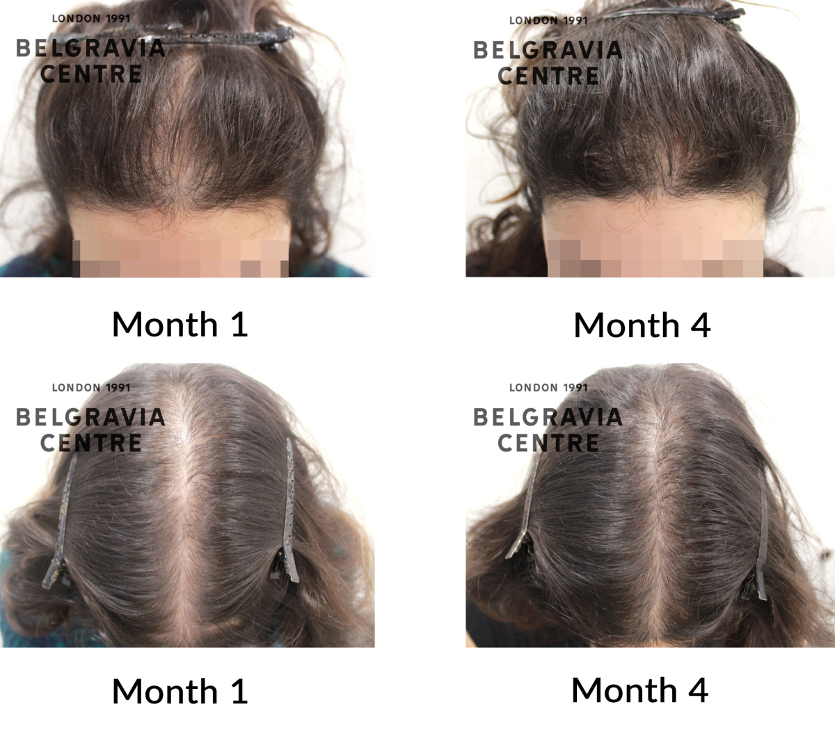 male pattern hair loss the belgravia centre 467736