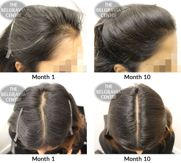 female pattern hair loss the belgravia centre tj 02 10 2019