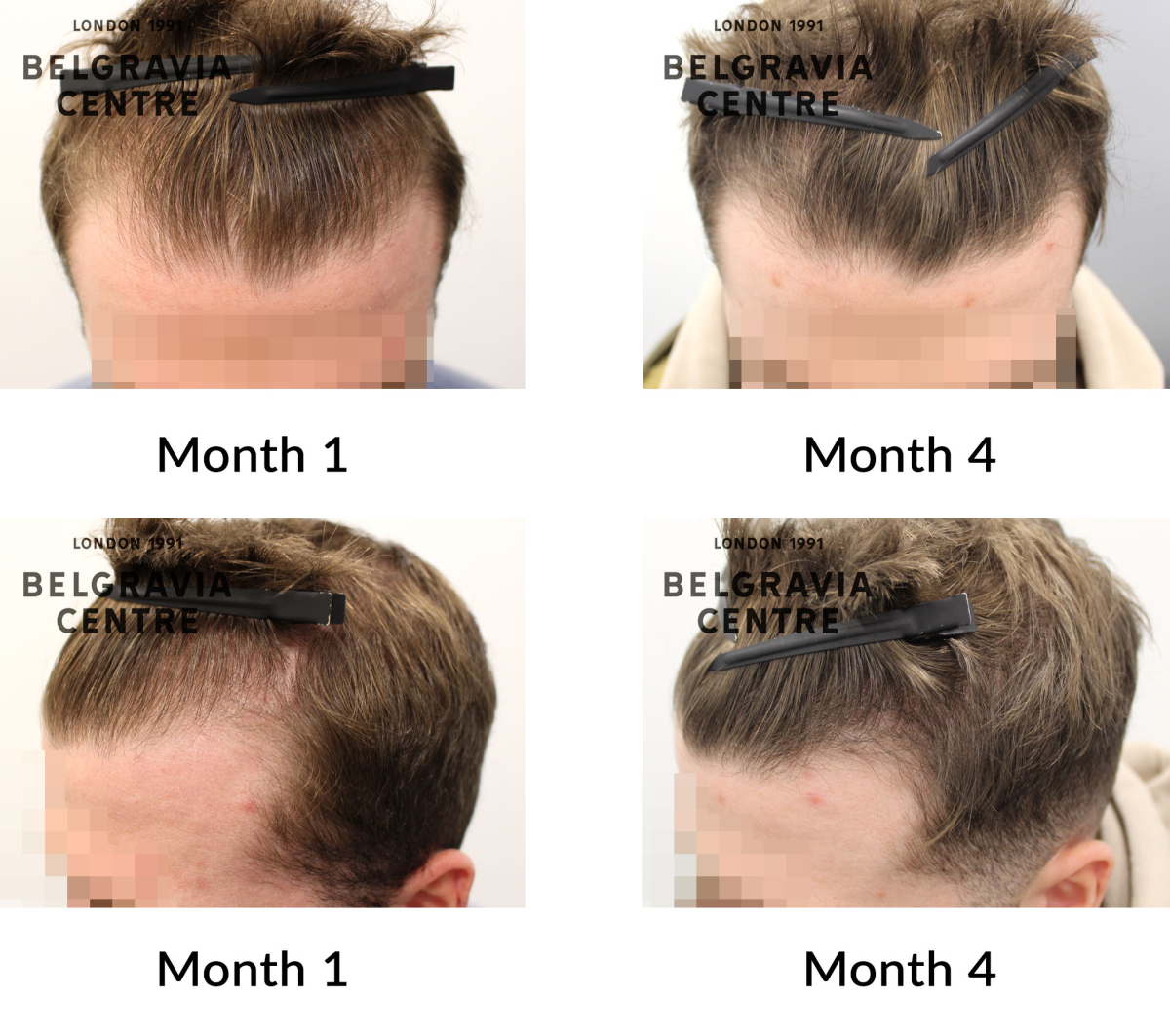 male pattern hair loss the belgravia centre 446673