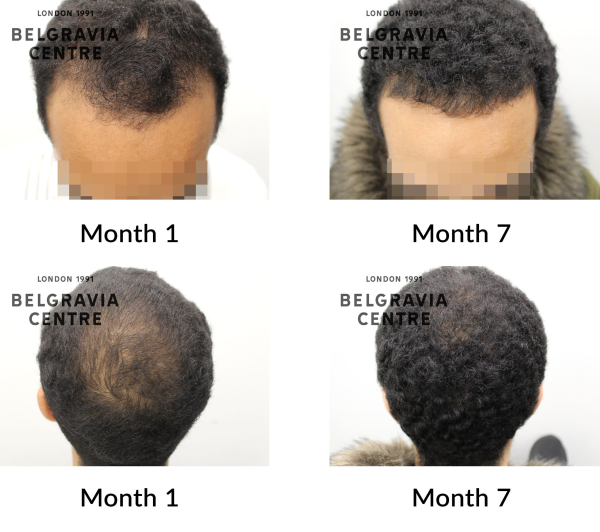 male pattern hair loss the belgravia centre 444104